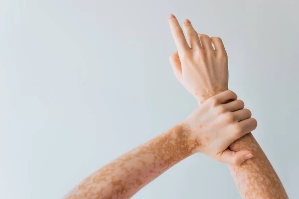 Cropped view of woman with vitiligo chronical skin condition on hands isolated on grey — Stock Photo