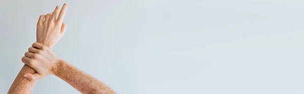 Обрізаний вид жінки з хронічним станом шкіри на руках ізольований на сірому, банер — стокове фото