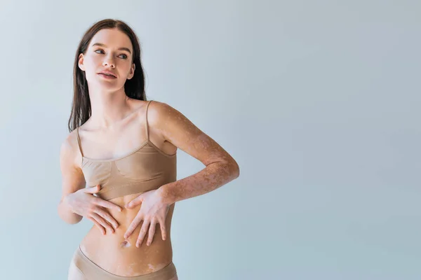 Donna bruna con vitiligine condizione della pelle cronica toccante pancia isolata sul grigio — Foto stock