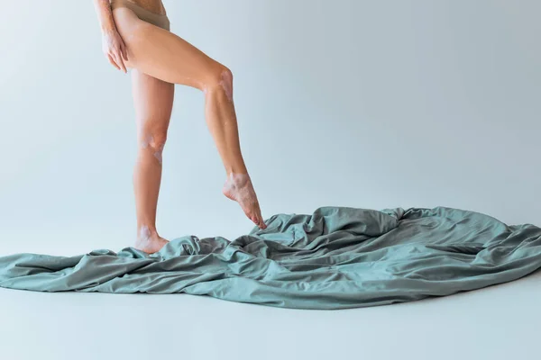 Частичный вид женщины с хроническим заболеванием кожи витилиго, стоящей рядом с одеялом на сером фоне — стоковое фото