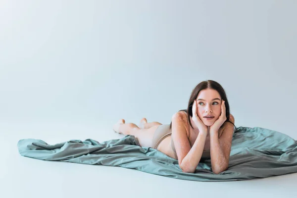 Молодая брюнетка женщина с хроническим заболеванием кожи витилиго лежит на одеяле на сером фоне — стоковое фото