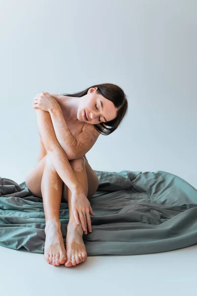 Чуттєва молода жінка з вітіліго хронічного стану шкіри, що сидить на ковдрі на сірому — стокове фото