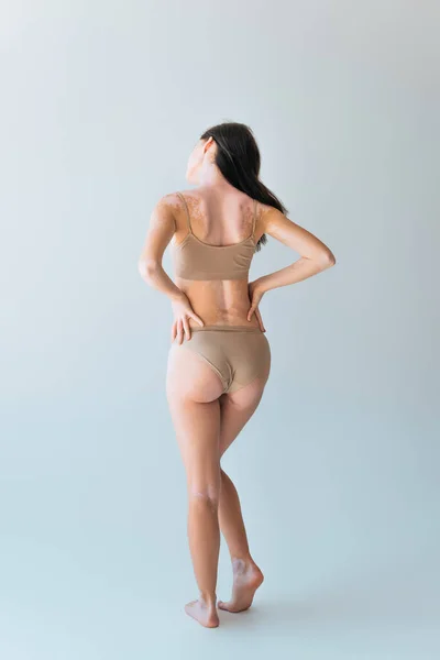 Vista posteriore di giovane donna con vitiligine in piedi con le mani sui fianchi su grigio — Foto stock