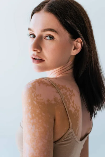 Portrait of brunette young woman with vitiligo looking at camera isolated on grey — Stock Photo