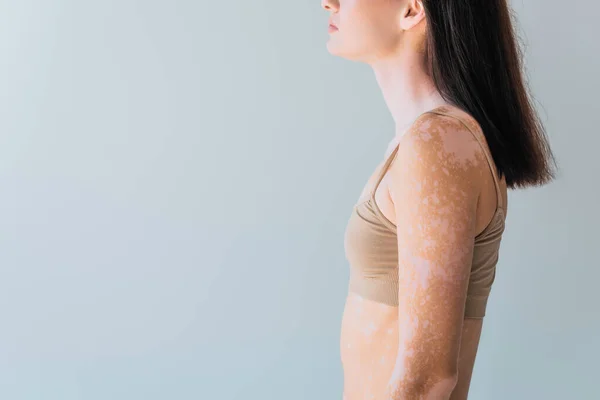 Cropped view of brunette young woman with vitiligo standing isolated on grey — Stock Photo