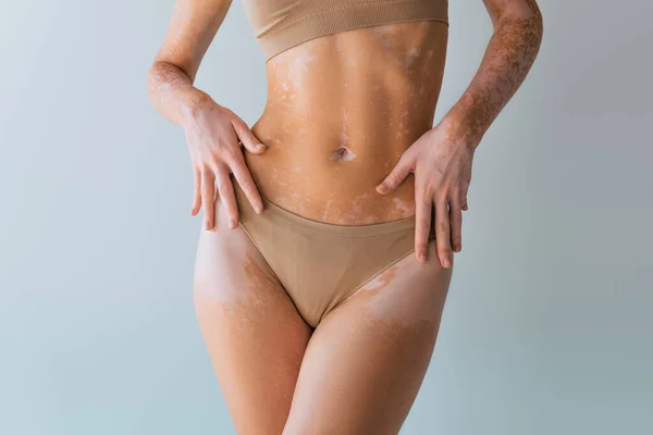 Vista parcial de una joven con vitiligo de pie en ropa interior aislada en gris - foto de stock