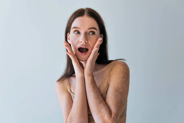 Amazed young woman with vitiligo looking away isolated on grey — Stock Photo