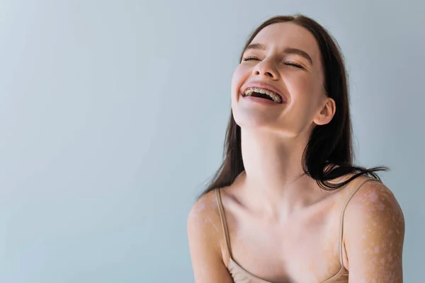 Happy young woman with vitiligo and braces laughing isolated on grey — Stock Photo