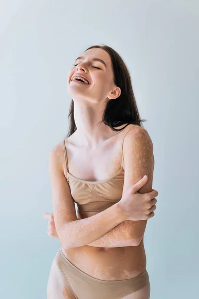 Cheerful young woman with vitiligo and braces smiling isolated on grey — Stock Photo