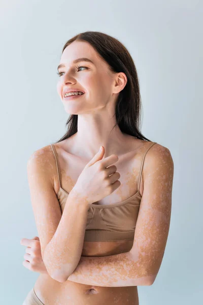 Positive young woman with vitiligo and braces smiling isolated on grey — Stock Photo