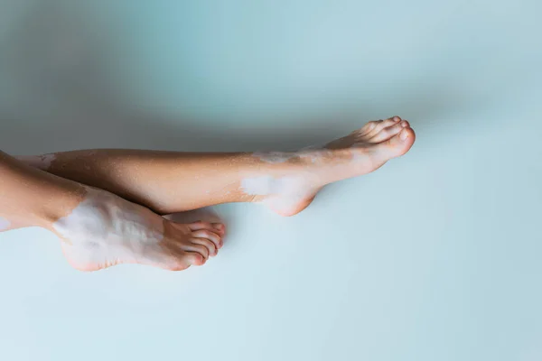 Vista recortada de la mujer con vitiligo y pies desnudos sobre fondo gris - foto de stock