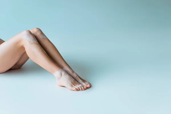 Partial view of woman with vitiligo and bare feet sitting on grey background — Stock Photo