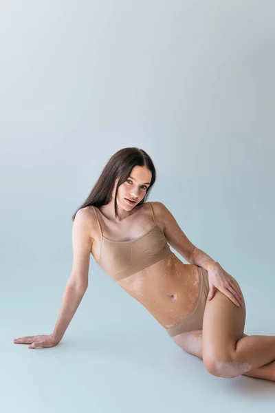 Jolie jeune femme avec vitiligo assis en lingerie beige et regardant la caméra sur gris — Photo de stock