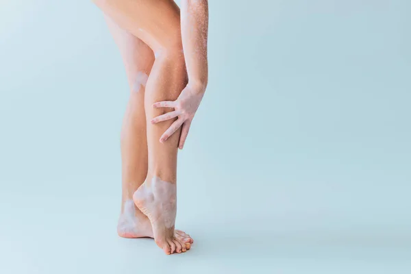 Vue partielle de jeune femme avec vitiligo et pieds nus debout sur fond gris — Photo de stock