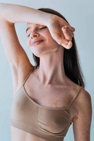 Retrato de mujer joven y contenta con vitiligo y ojos cerrados posando aislados sobre gris - foto de stock