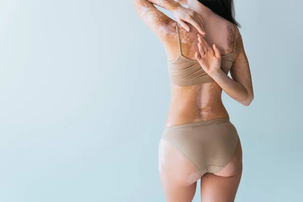 Vista posterior de mujer joven con vitiligo tocando los dedos detrás de la espalda mientras está de pie aislado en gris - foto de stock