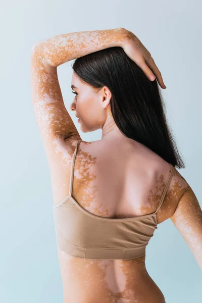 Mujer joven con vitiligo tocando el pelo moreno mientras mira hacia otro lado aislado en gris - foto de stock