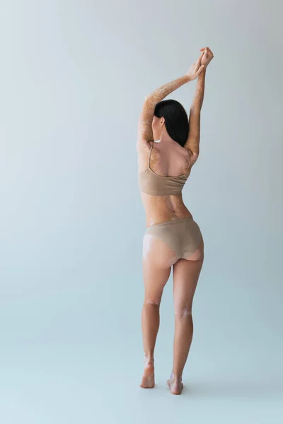 Vista posteriore di bruna giovane donna con vitiligine posa in lingerie beige su grigio — Foto stock