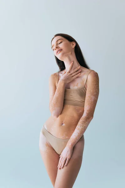 Young woman with vitiligo touching chest while posing with closed eyes isolated on grey — Stock Photo