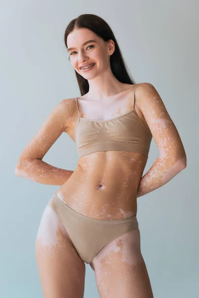 Jovem feliz com vitiligo e aparelho sorrindo e de pé isolado em cinza — Fotografia de Stock