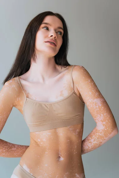 Mujer joven con vitiligo de pie en sujetador superior beige y mirando hacia otro lado aislado en gris - foto de stock