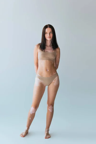 Piena lunghezza di giovane donna sorridente con vitiligine posa in lingerie beige su grigio — Foto stock
