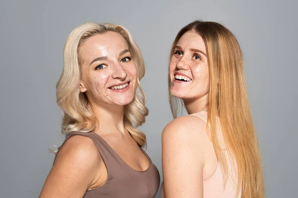 Modelos alegres com sardas e acne sorrindo isolado em cinza — Fotografia de Stock