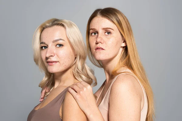 Frau mit sommersprossiger Haut umarmt Freund mit Akne isoliert auf grau — Stockfoto
