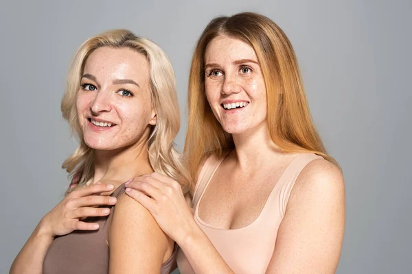 Mujeres sonrientes con problemas de piel de pie aisladas en gris - foto de stock