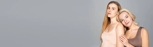 Donna sorridente con acne in piedi vicino amico con lentiggini isolate sul grigio, banner — Foto stock