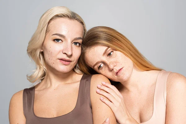 Donna sconvolta con pelle lentigginosa appoggiata sulla spalla di un amico con acne isolata sul grigio — Foto stock