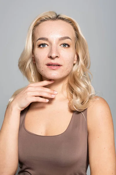 Hübsche blonde Frau mit Akne am Hals isoliert auf grau — Stockfoto