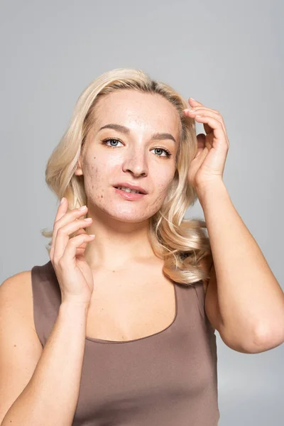 Portrait of blonde woman with skin issues looking at camera isolated on grey — Stock Photo