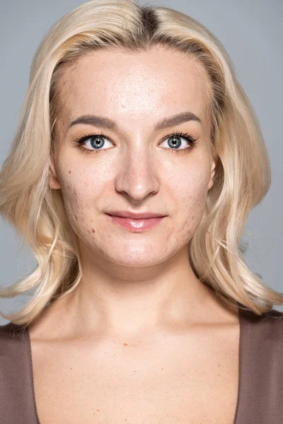 Ritratto di donna bionda con acne sul viso guardando la macchina fotografica isolata sul grigio — Foto stock