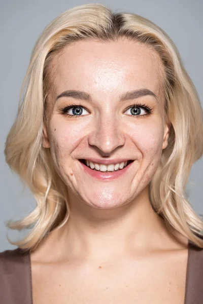 Portrait de femme blonde souriante avec problème de peau regardant la caméra isolée sur gris — Photo de stock