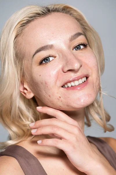 Retrato de mujer alegre con acné en la piel posando aislado en gris - foto de stock