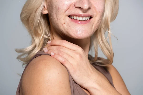 Vista cortada de mulher sorridente com acne na pele do problema isolado no cinza — Fotografia de Stock