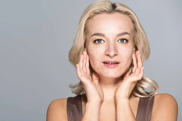Femme blonde avec acné et problème de peau toucher le visage isolé sur gris — Photo de stock
