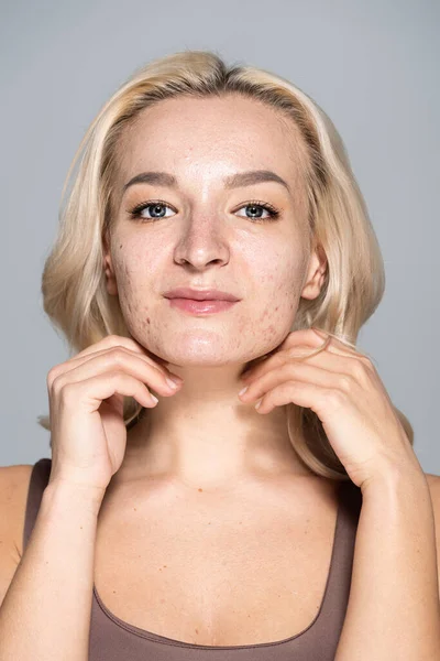 Portrait of blonde woman with skin issue on face isolated on grey — Stock Photo