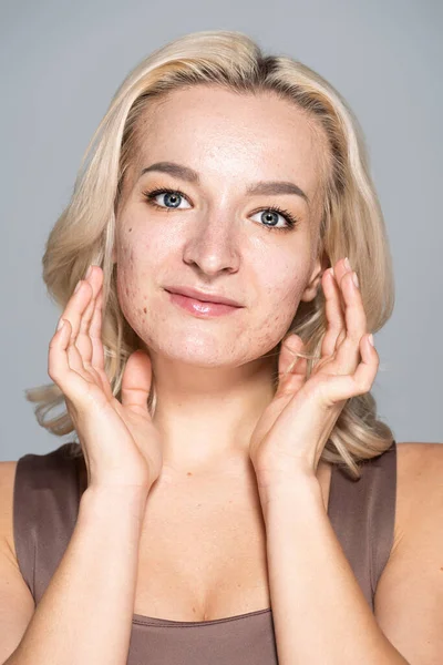 Pretty blonde woman with skin issue and acne posing isolated on grey — Stock Photo
