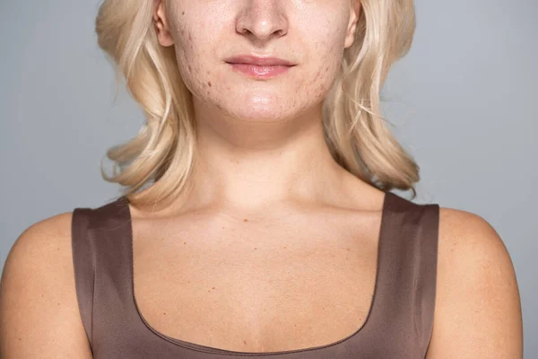 Обрезанный вид блондинки с проблемной кожей, стоящей изолированно на сером — стоковое фото