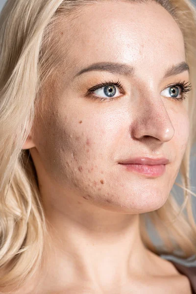 Portrait of woman with problem skin and acne looking away isolated on grey — Stock Photo