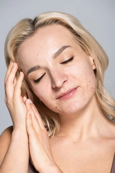 Modèle blond avec acné sur peau problématique posant isolé sur gris — Photo de stock