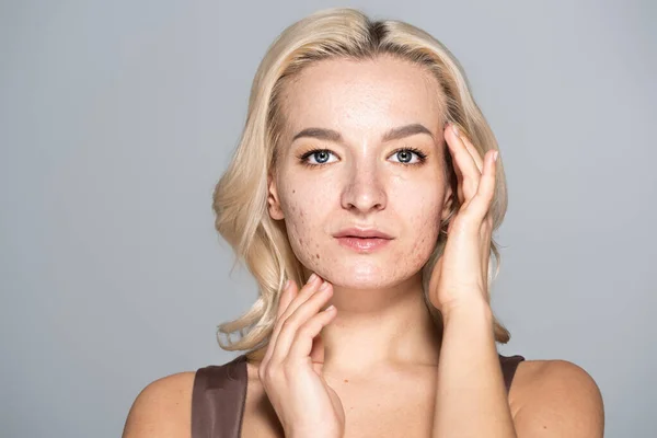 Портрет блондинки з проблемою шкіри, що торкається обличчя ізольовано на сірому — стокове фото