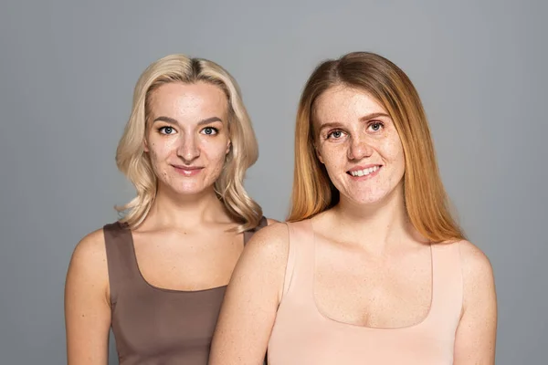 Donne sorridenti con problemi di pelle guardando la fotocamera isolata sul grigio — Foto stock