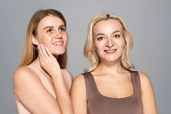 Mujeres alegres con problemas de piel posando aisladas en gris - foto de stock