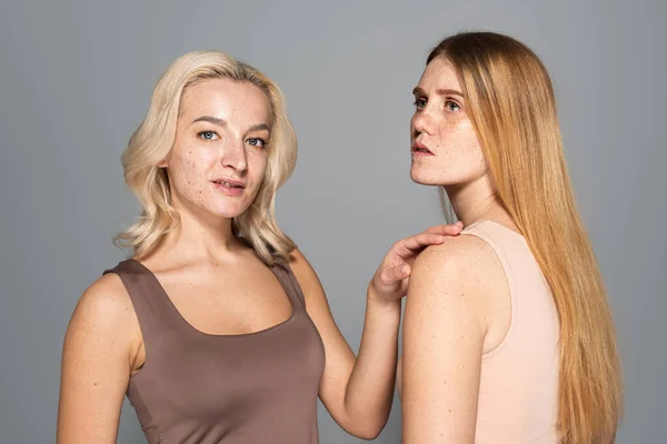 Smiling model with problem skin standing near friend with freckles isolated on grey — Stock Photo