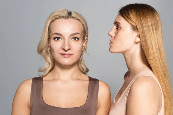 Retrato de mulheres com acne e sardas na pele isoladas em cinza — Fotografia de Stock