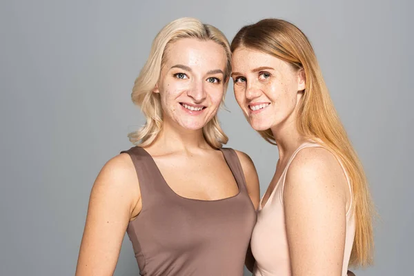 Щасливі друзі з проблемною шкірою стоять ізольовані на сірому — стокове фото