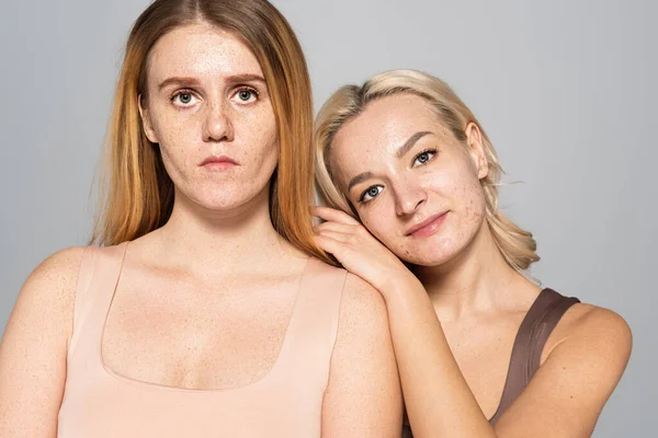 Mulher loira com acne no rosto em pé perto de amigo com sardas isoladas em cinza — Fotografia de Stock